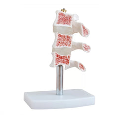 Osteoporosis Cutaway Anatomical Model