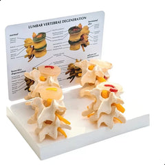 Lumbar Vertebrae 4-Stage Degenration Model
