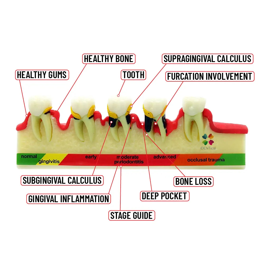 Periodontal Disease Model-Stages of Periodontitis