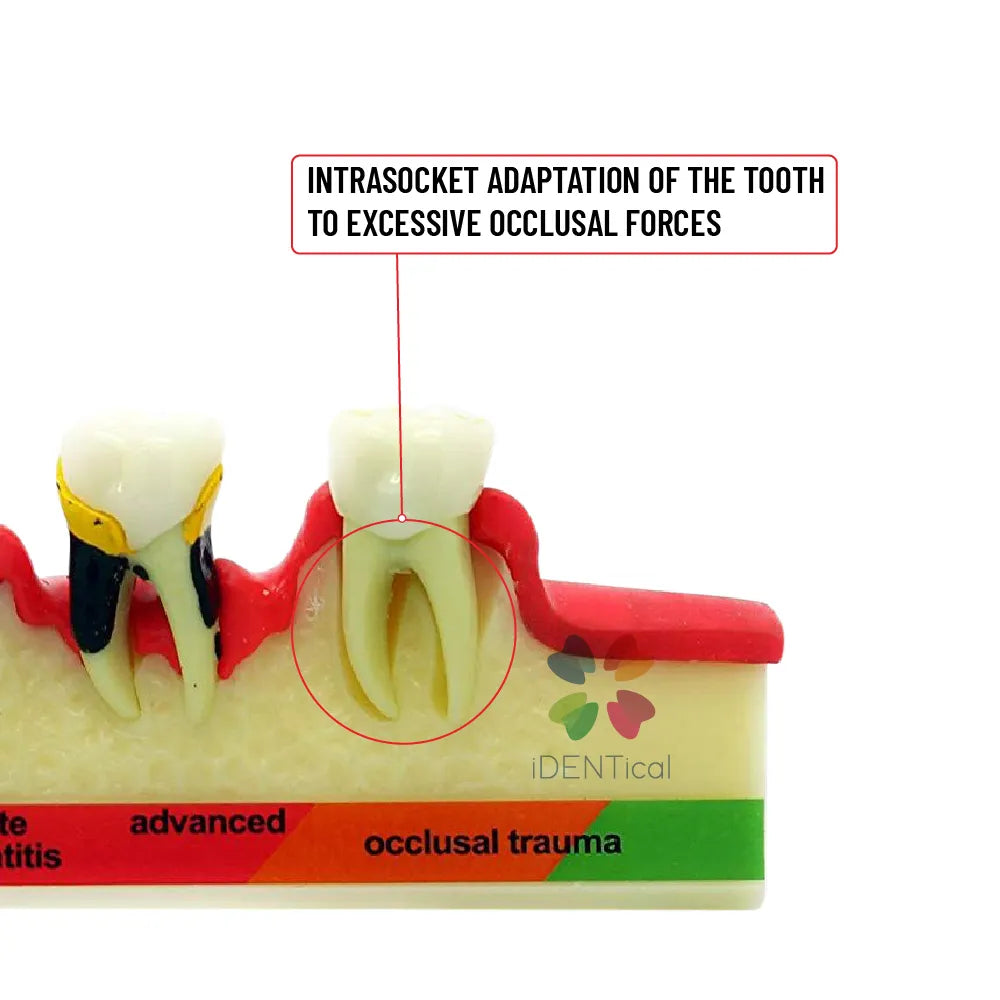 Periodontal Disease Model-Stages of Periodontitis