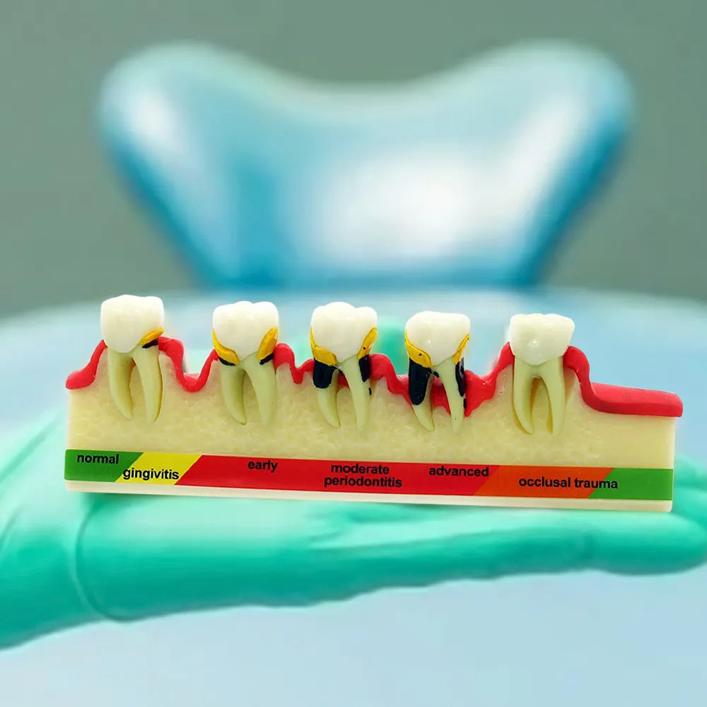 Periodontal Disease Model-Stages of Periodontitis