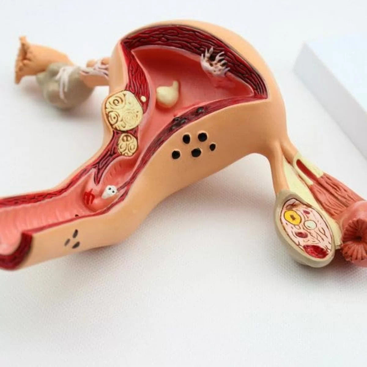 Uterus Ovary Model With Pathologies