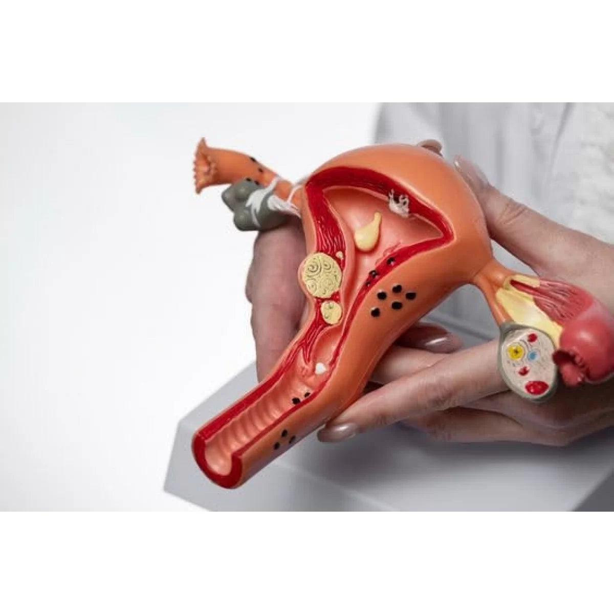 Uterus Ovary Model With Pathologies