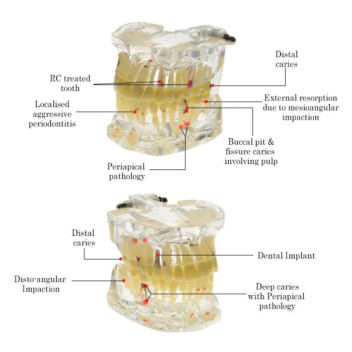 Dental Model With Pathologies (Transparent)