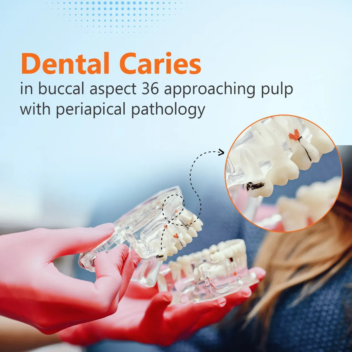 Dental Model With Pathologies (Transparent)