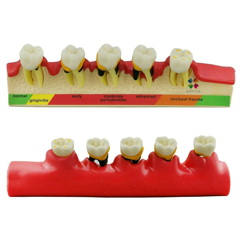 Periodontal Disease Model-Stages of Periodontitis