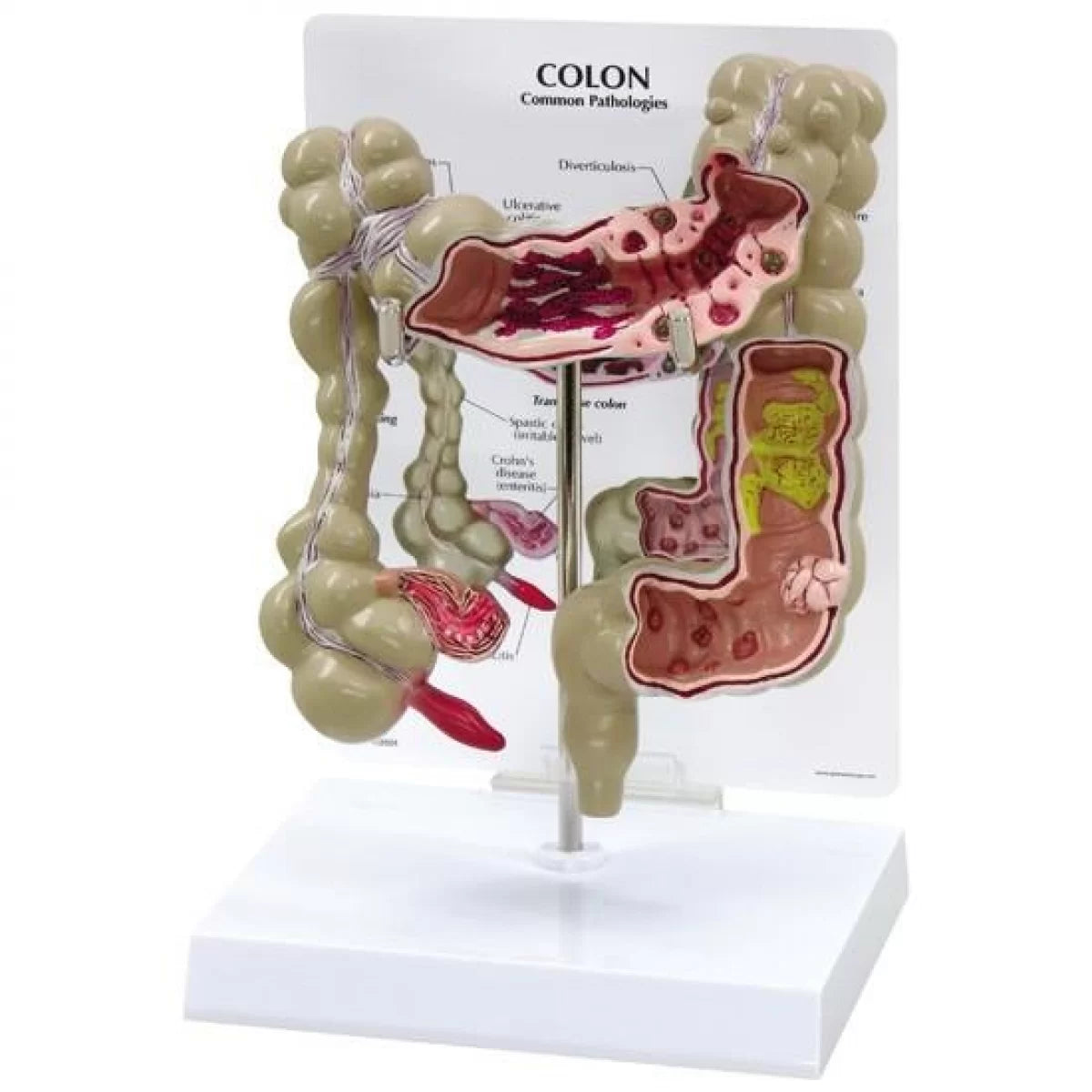 Colon Pathological Model - Human Intestine