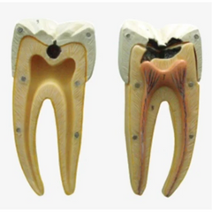 Dental Caries Model (Giant Size)