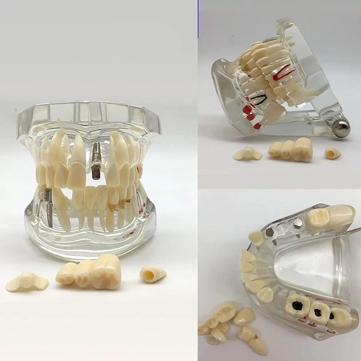 Dental Model With Pathologies (Transparent)