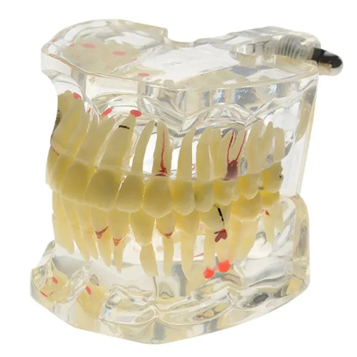 Dental Model With Pathologies (Transparent)